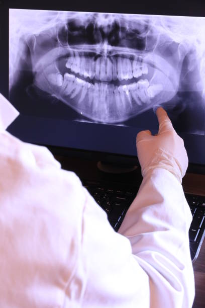 Best Knocked-Out Tooth (Avulsed Tooth) Treatment in Rose Hills, CA